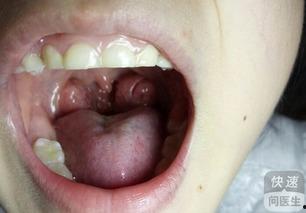 扁桃体发炎还吃哈密瓜嘛,哈密瓜食用指南