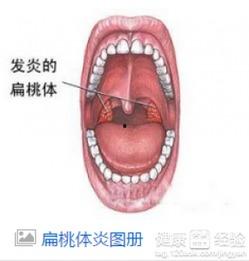 扁桃体发炎还吃哈密瓜嘛,哈密瓜食用指南